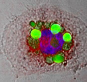 A macrophage foam cell contained fat droplets (green) that are surrounded by CEH (red) showing how this enzyme associates with fat and releases cholesterol to be picked up by HDL. The nucleus of the cell is stained blue. 
Image courtesy of Bernard J. Fisher/VCU.