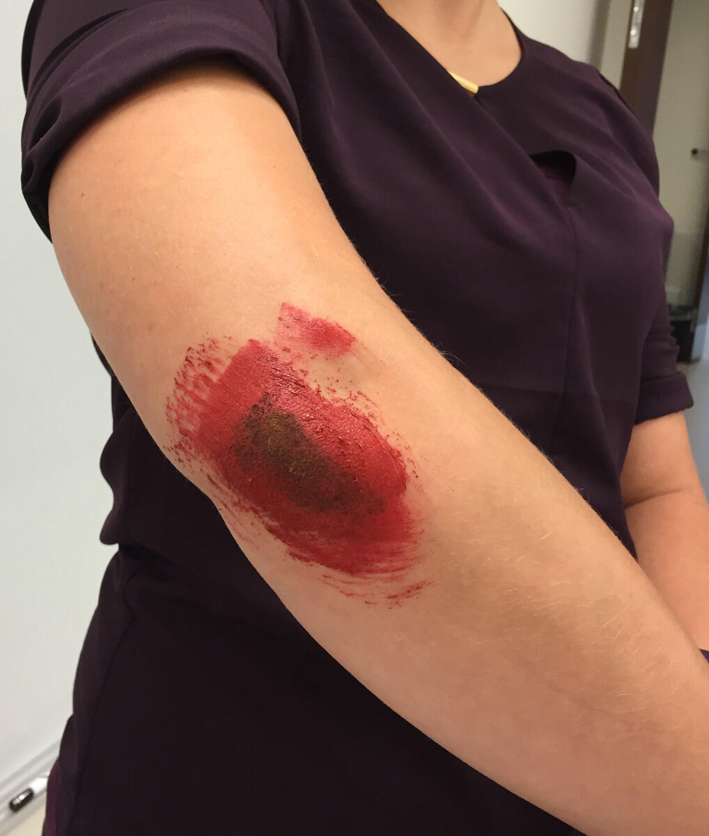 A road rash “patient’s” painted abrasion was used to demonstrate how to clean, treat and bandage common bike injuries.