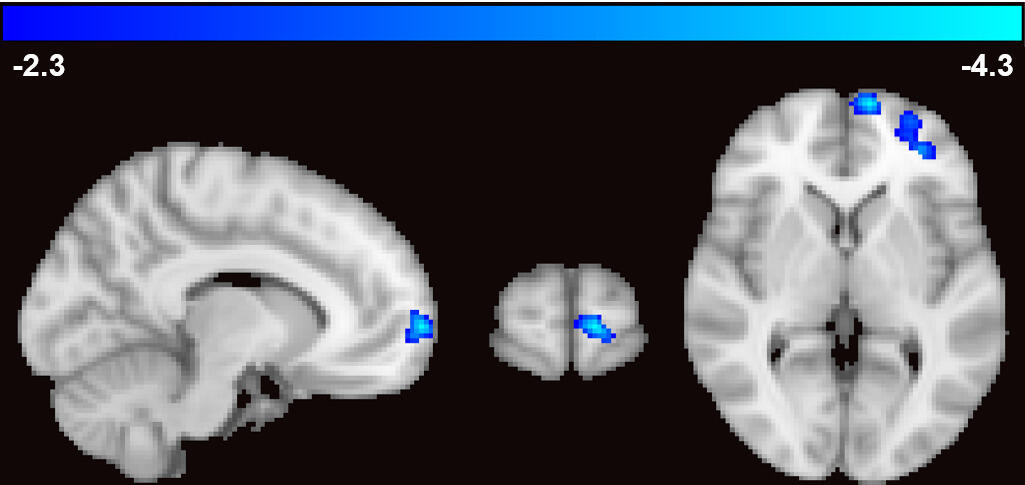 A fMRI image