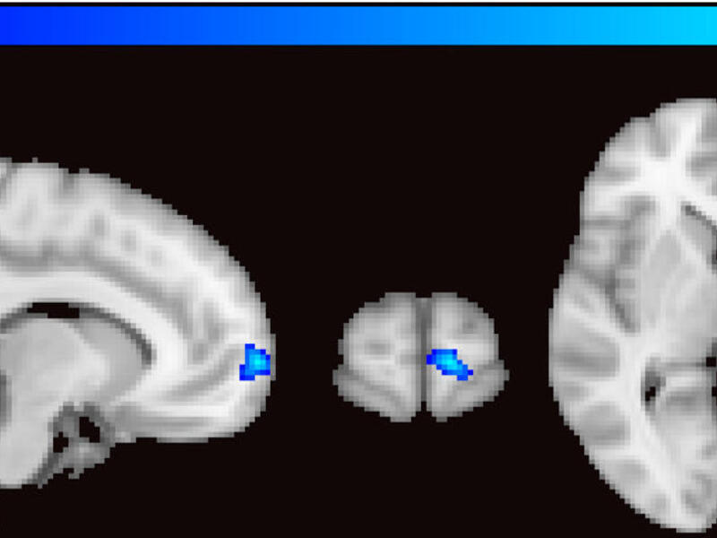 A fMRI image of the MPFC brain region that is blunted for intimate partner aggression, as compared to aggression against close friends and strangers.