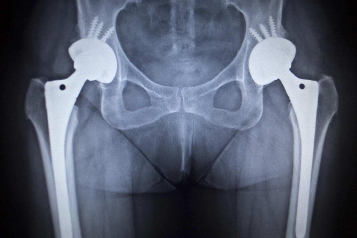 X-ray scan of a hip joint replacement orthopedic implant.