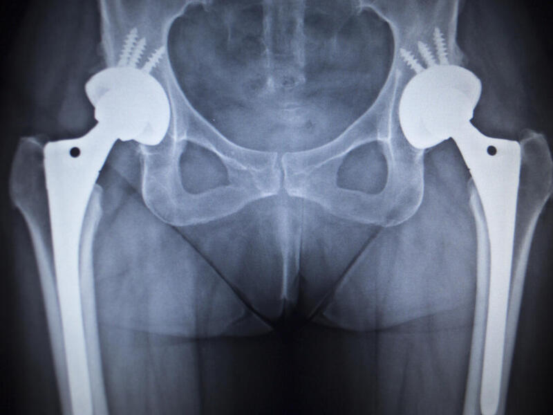 X-ray scan of a hip joint replacement orthopedic implant.