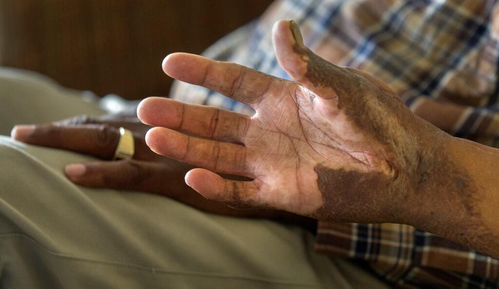 Terry Langhorne suffered fourth-degree burns to his upper body, including his hands.