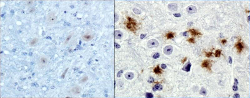 Left: Normal brain tissue. Right: Plaque stains from abnormal amyloid fibrils. 