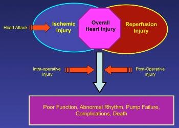 Overall injury sustained by the heart is the sum of heart attack injury before surgery, injury acquired by the heart during surgery, which is caused by the artificial heart and lung machine and cross clamping of large and small vessels (intra-operative injury) and the initial reperfusion injury, which is triggered at the time of complete restoration of warm blood flow to cold arrested hearts. Prolonged poor cardiac function and abnormal rhythm after surgery may lead to serious complications and cardiac arrest. Images provided by Anwar Abd-Elfattah, Ph.D., professor of cardiothoracic surgery in the Virginia Commonwealth University School of Medicine.