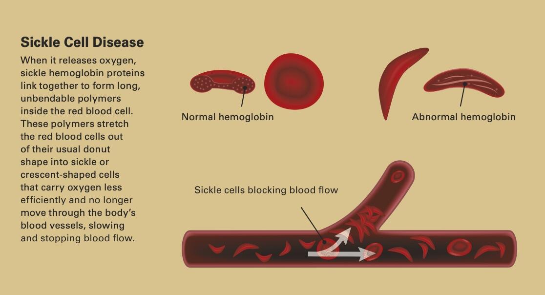 A graphical explanation of sickle cell disease: When it releases oxygen, sickle hemoglobin proteins link together to form long unbendable polymers inside the red blood cell. These polymers stretch the red blood cells out of their usual donut shape into sickle or crescent-shaped cells that carry oxygen less efficiently and no longer move through the body's blood vessels, slowing the stoping blood flow.