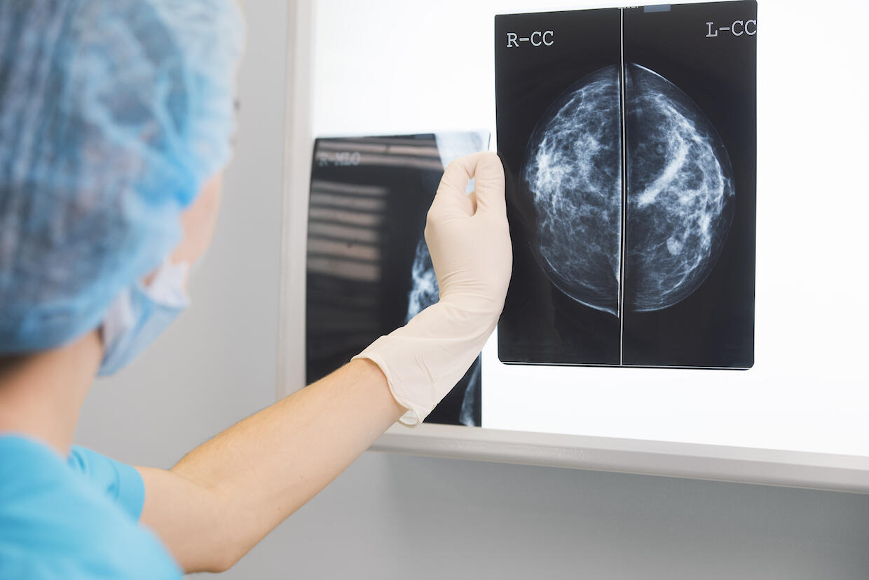 A person in blue medical scrubs and gloves holds a medical image of a breast on a lightbox.