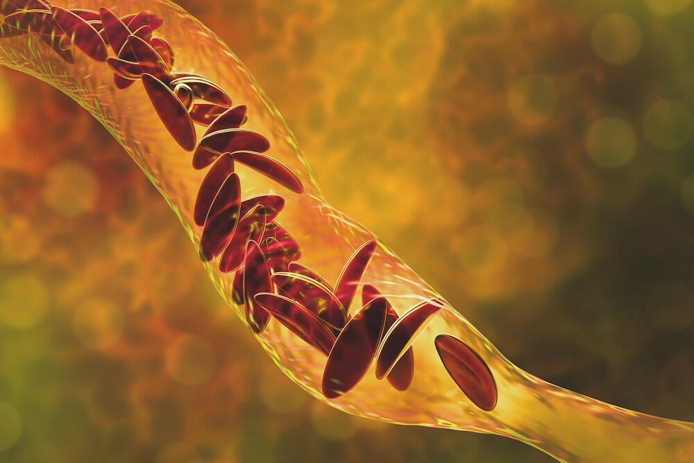 An illustration of sickle cells in blood vessel.