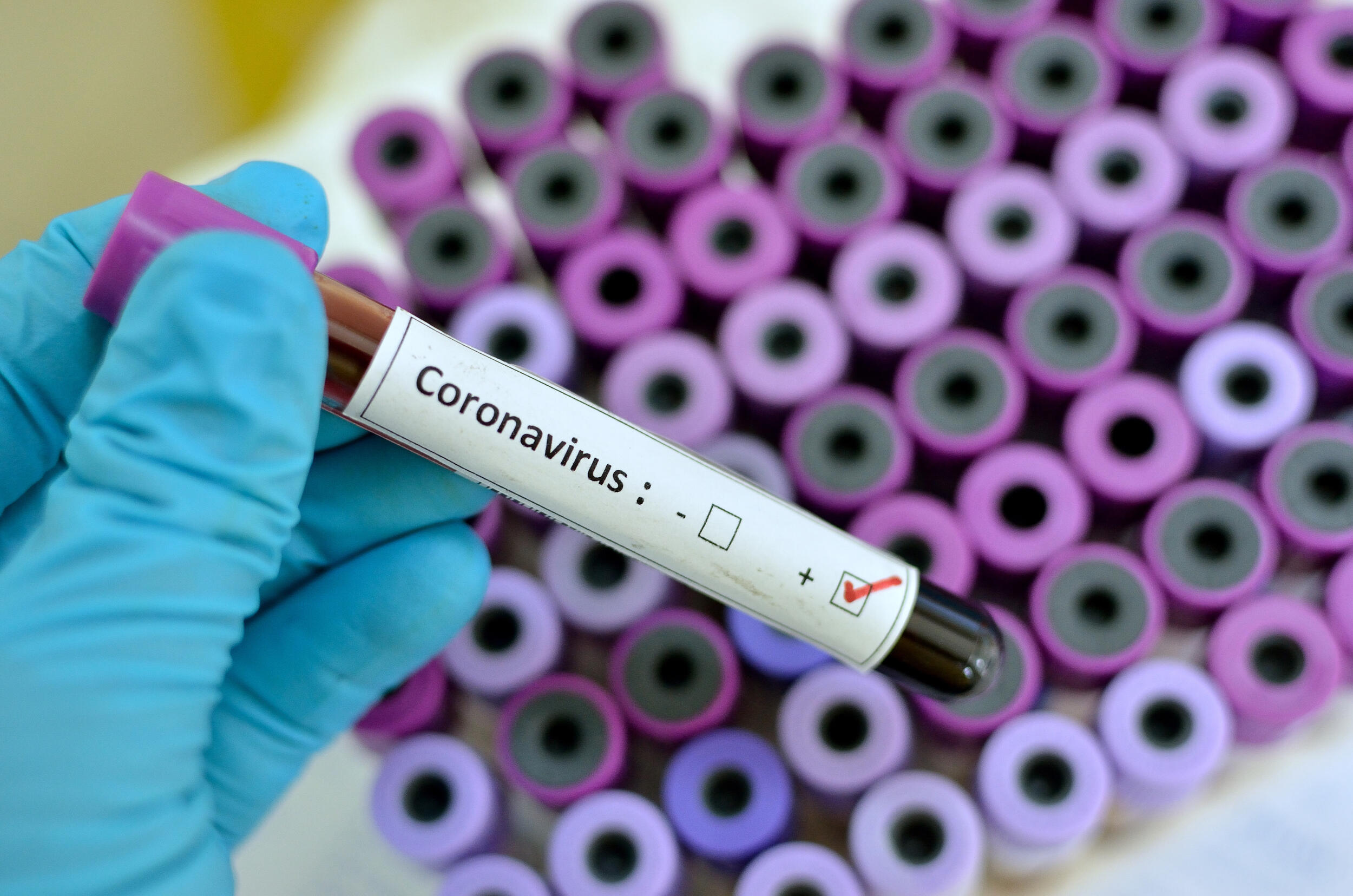 A vial with the word \"coronavirus\" listed.